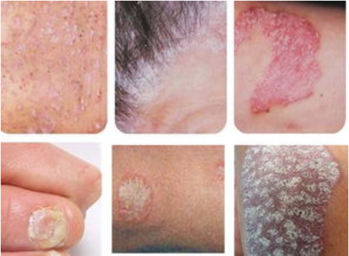 When you get psoriasis what could it lead to