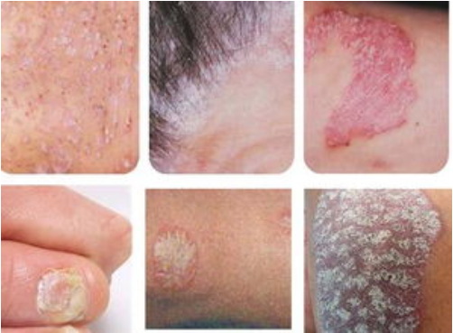 Cuando tienes psoriasis, ¿a qué podría conducir?