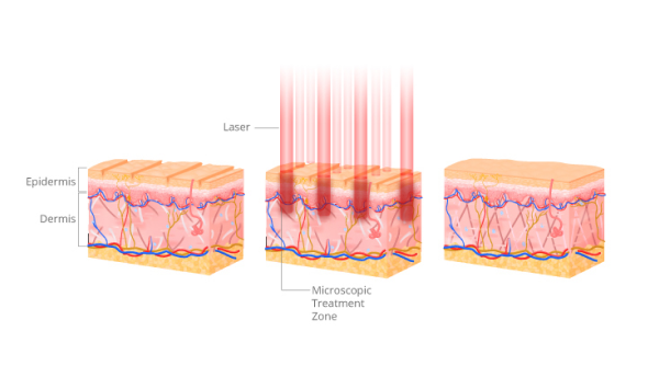 1550nm Erbium Laser